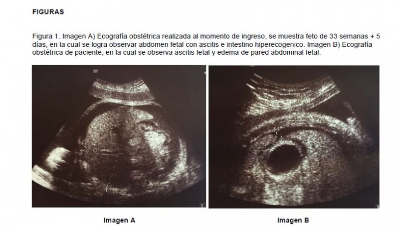 ASCITIS FETAL COMO MANIFESTACIÓN DE PERITONITIS MECONIAL; PRESENTACIÓN DE UN CASO Y REVISIÓN DE